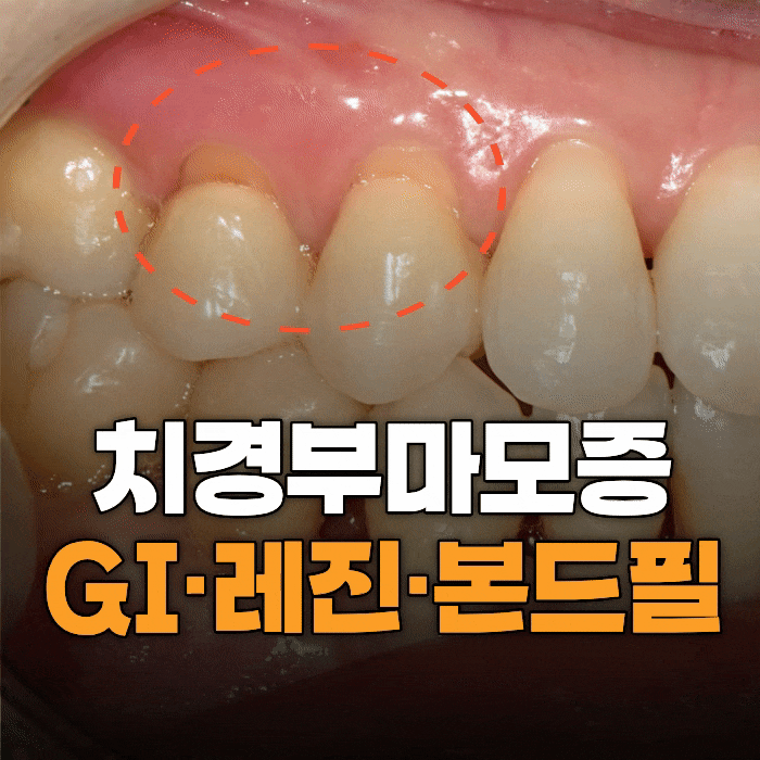  치경부 마모증 치료, 왜 자꾸 떨어질까? GI·레진·본드필 선택 기준