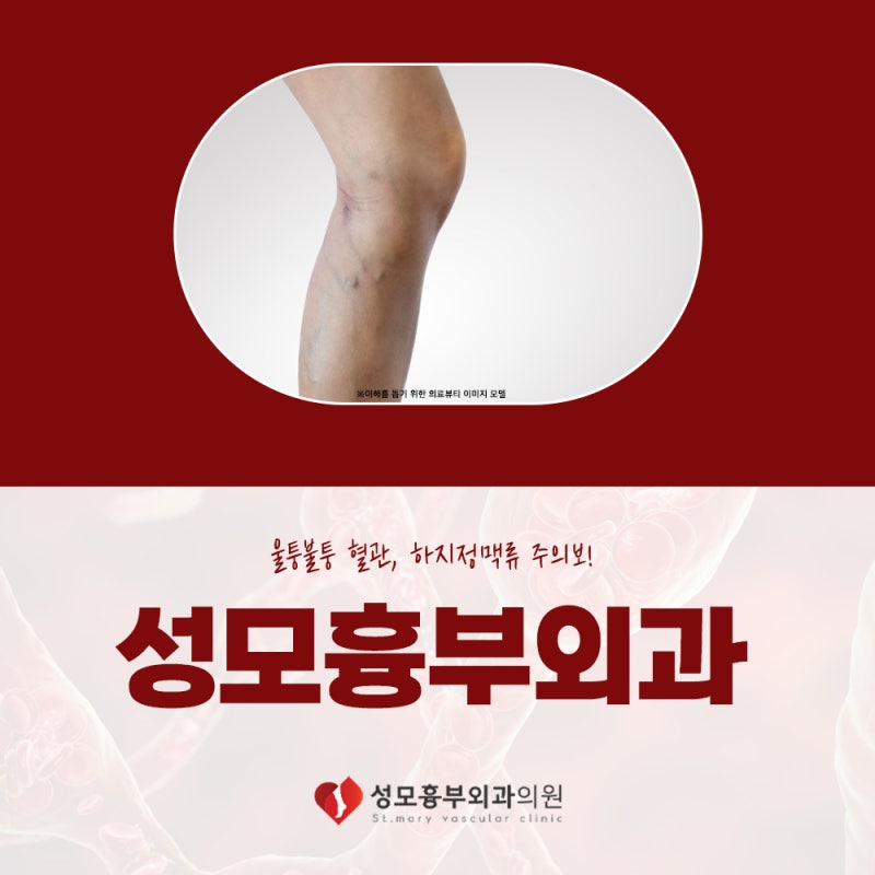 청주하지정맥류 오른쪽종아리통증 증상 원인은?