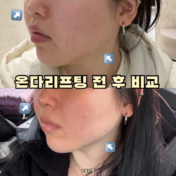  강남역온다리프팅 전후 비교 중안부 축소 턱선 볼 처짐 후기