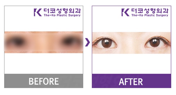 광주안과안검하수 · 눈매교정술 , 성형외과전문의 추천 졸린눈교정 잘하는곳