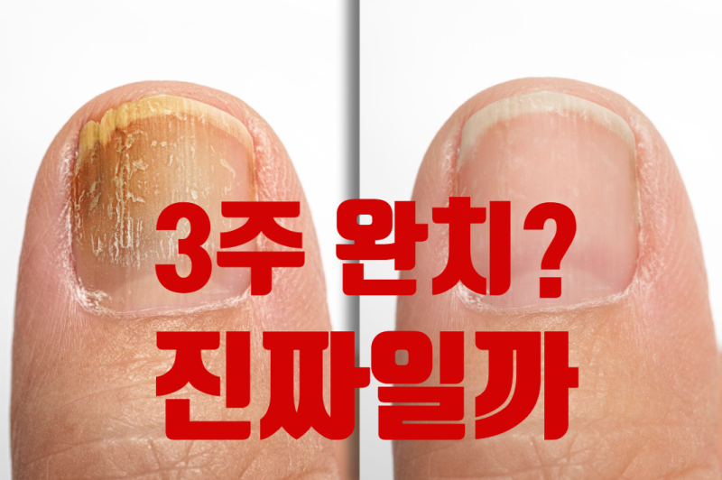 “발톱무좀 3주 완치?” SNS 광고 믿어도 될까… 피부과 전문의가 말한 진짜 치료 기간
