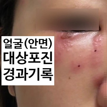 30대 눈쪽 얼굴 대상포진 초기증상... 경과 기록과 피부과 치료 후기