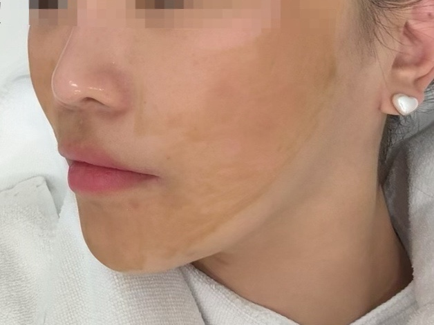 여의도 여드름 색소침착 관리 하이필스킨 솔루션테라피 후기 (좁쌀·압출 자국 개선)