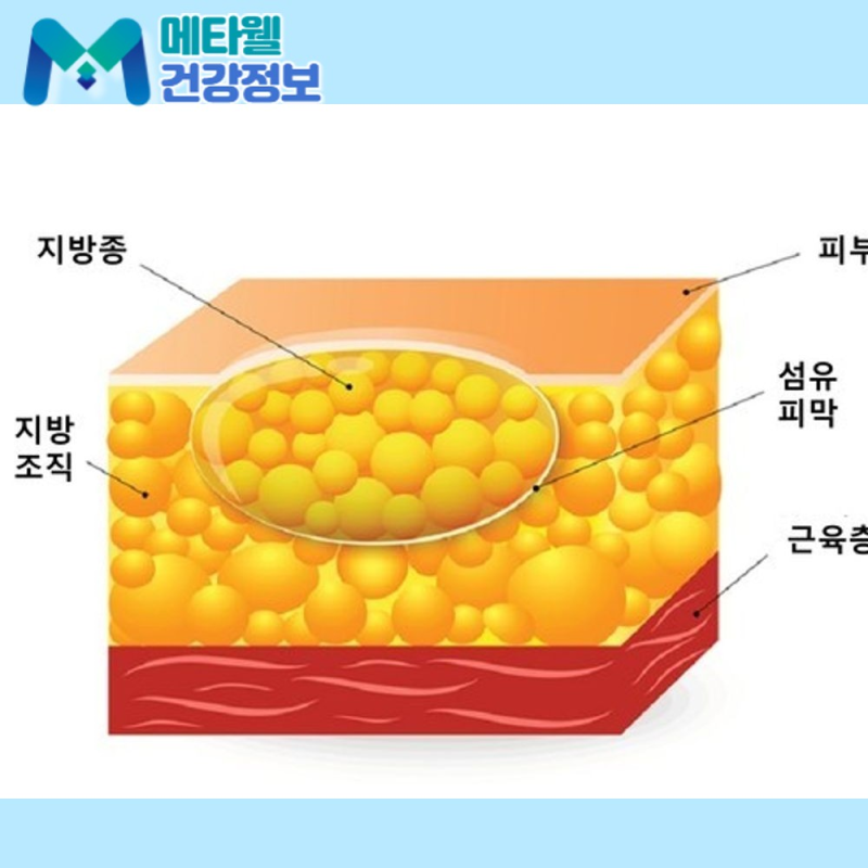 몸에 말랑한 혹이 생겼다면? 지방종 원인과 수술 여부 판단법