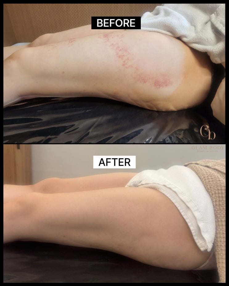  지방흡입후관리 왜 중요할까? 붓기,바이오본드 정리하면 라인이 이렇게 달라집니다