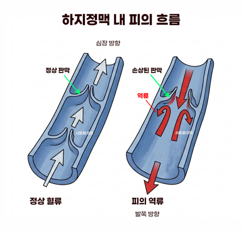 수원 하지정맥류 의심 증상 있다면 어떤 검사를? (서울88의원)