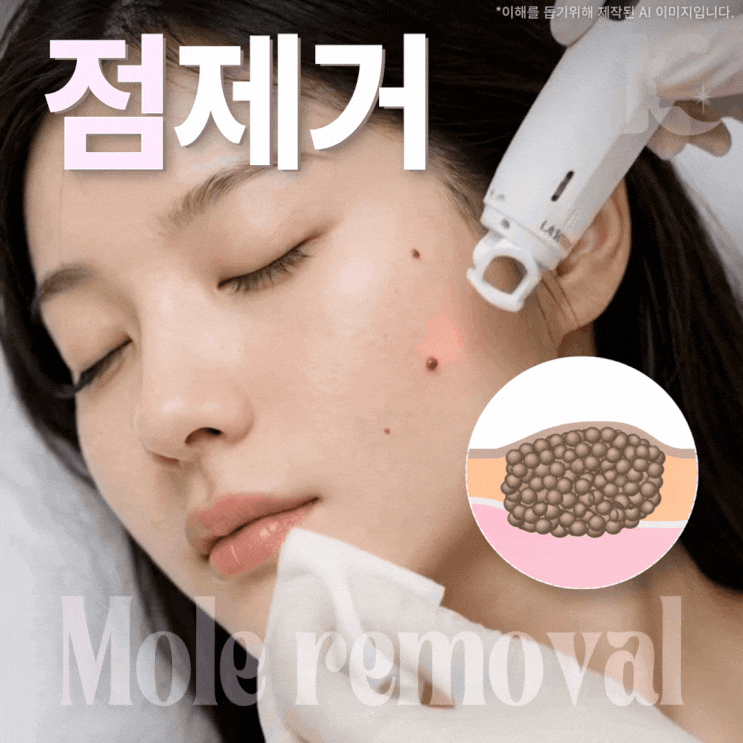  광주점제거 아이스 레이저로 튀어나온 큰점 빼는곳 가기 전 체크 광산구피부과 칼럼