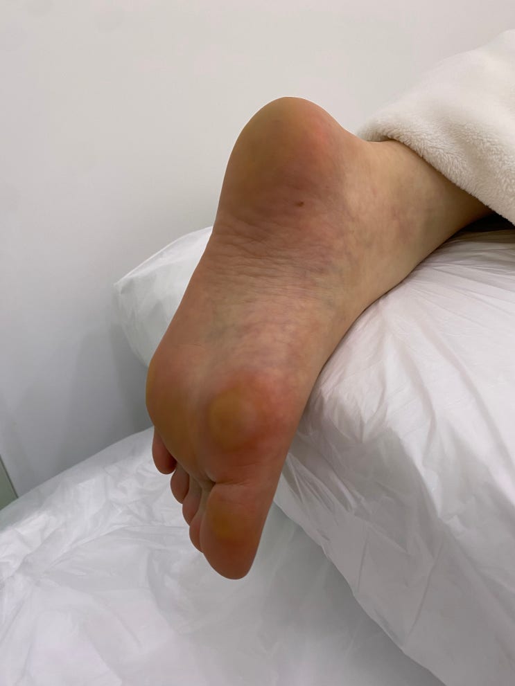  충주내성발톱 발각질 관리 만족 후기 바미네일 레푸스 충주연수점