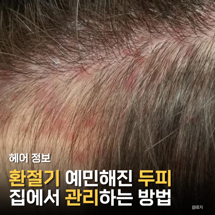  "환절기 예민해진 지성 민감성 두피 관리 집에서 홈케어 하는방법"