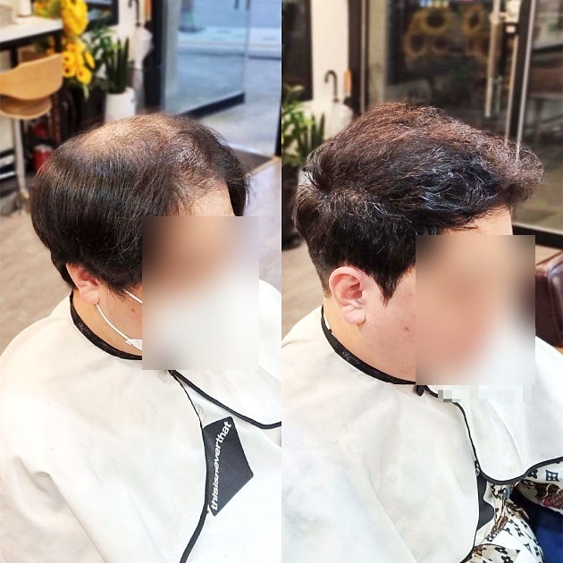  인천 정수리 탈모 고민, 심하게 비어 보이는 정수리도 링거펌 모류교정으로 커버될까요?