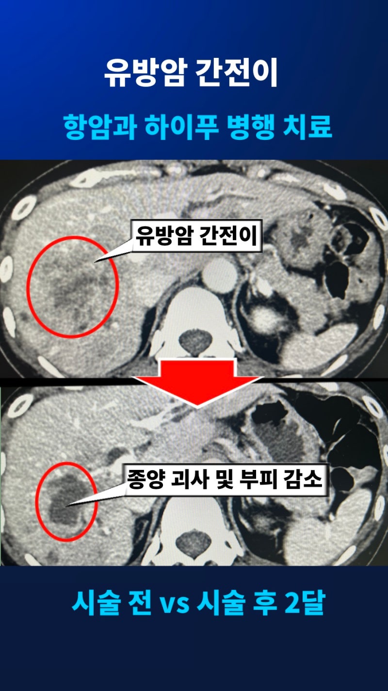 유방암 간전이