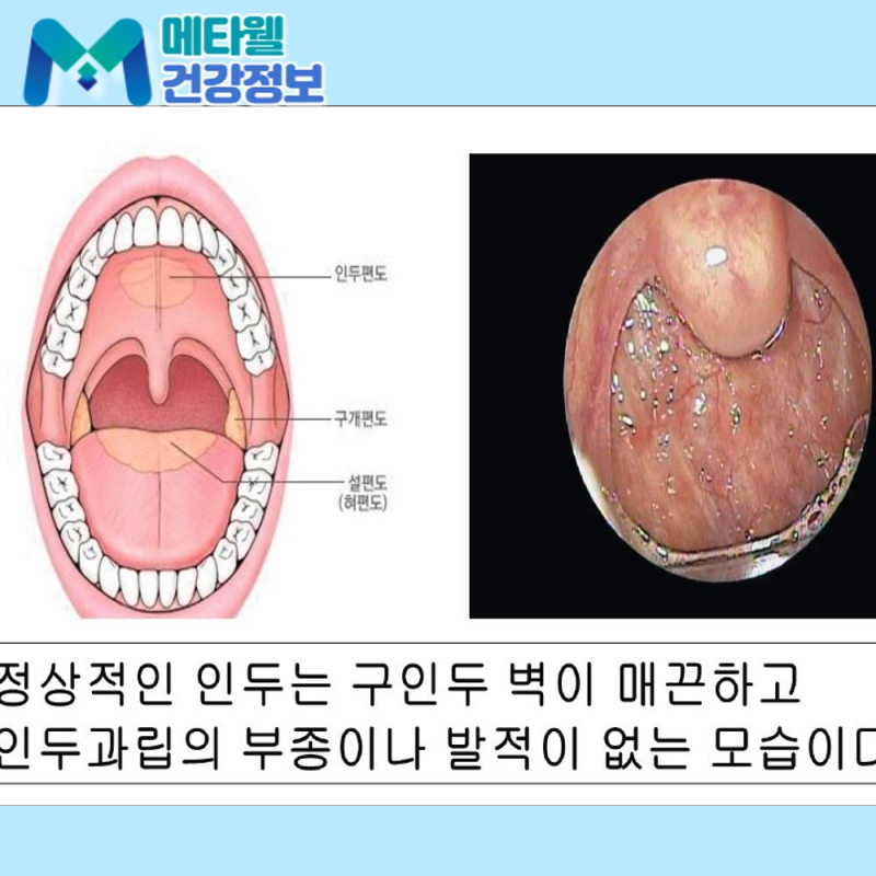 인후염, 전염될까? 약국에서 살 수 있는 약은? 급성·만성 증상과 치료법 정리