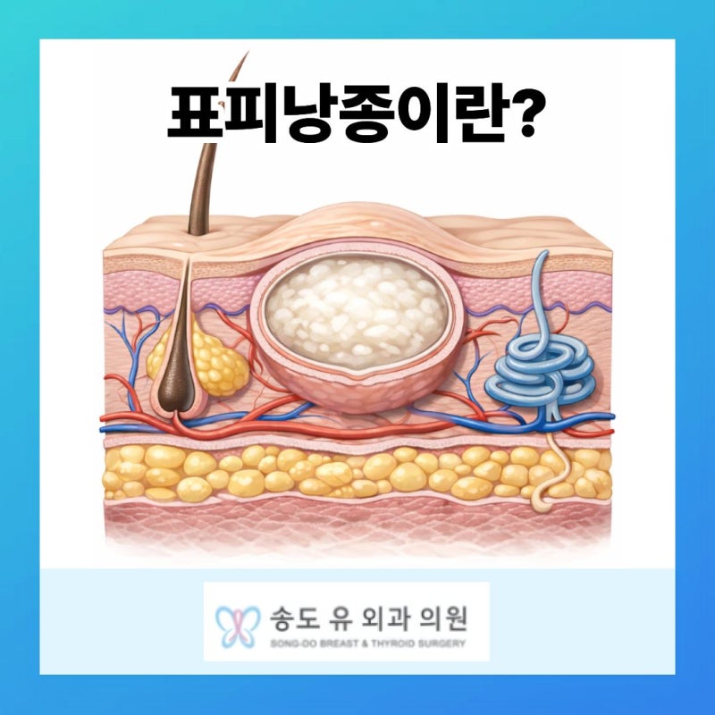 인천 표피낭종 제거, 왜 염증이 없을 때 수술해야 할까요?