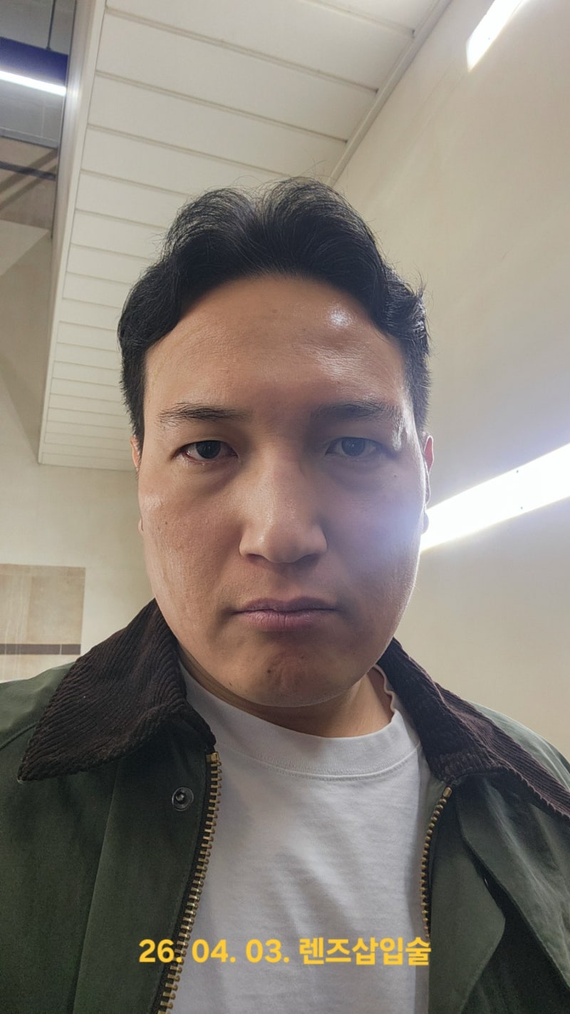 45살 아재 렌즈삽입술 후기