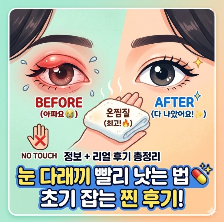눈다래끼 초기증상 대처법 (약국 점안액, 항생제 치료 후기)