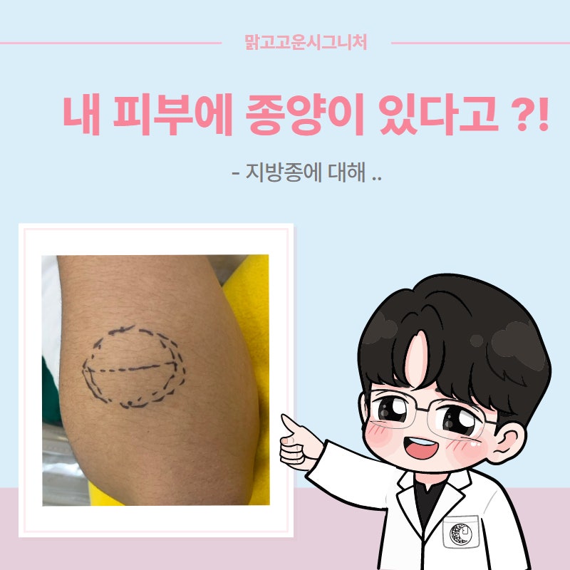 인천 지방종,표피낭종,피지낭종 제거는 어떻게 진행하는 걸까? 팔에 생긴 엄청나게 큰 낭종....
