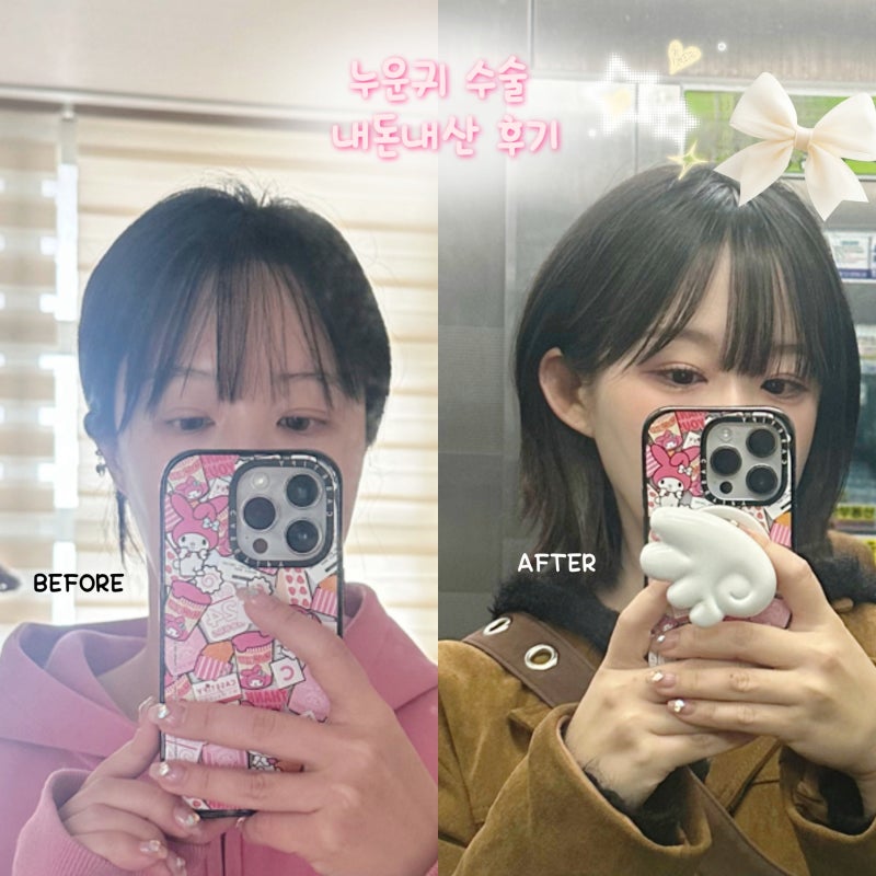 내돈내산 누운귀 성형 수술 1달 후기 엘프귀 붓기, 아픔, 흉터, ( 필러X 아님)