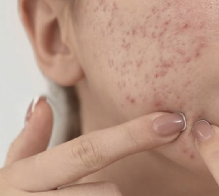  자꾸 피부 트러블 난다면? 제일 먼저 체크할 원인, 화장품 유통기한