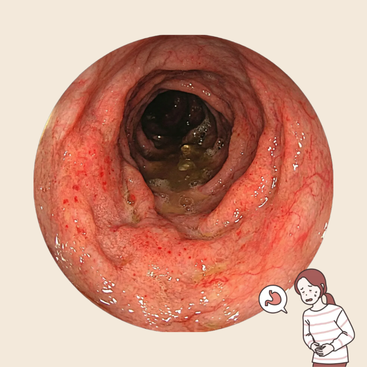  광주 북구 내과 만성 표재성 위염 치료
