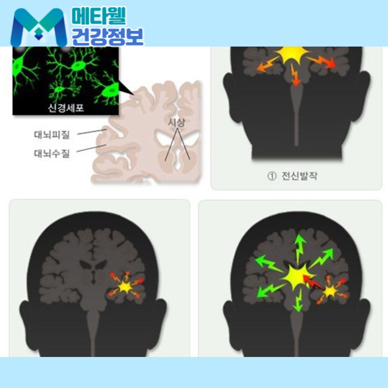 "간질"이 아닙니다. 뇌전증 전조증상·원인·치료법 그리고 발작 대처법