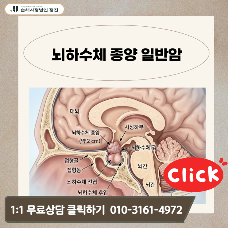  뇌하수체 종양 일반암, D35.2인데 왜 0원? 전액 뒤집은 실무 공개