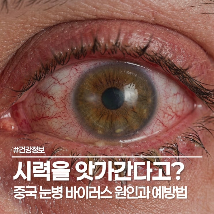  흰다리새우가 실명을 유발한다고? 중국 눈병 바이러스 원인과 예방법