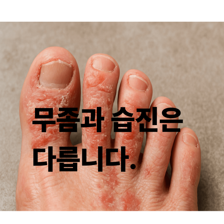  발가락 습진, 반복되던 가려움이 사라진 이유 (실제 환자 사례)