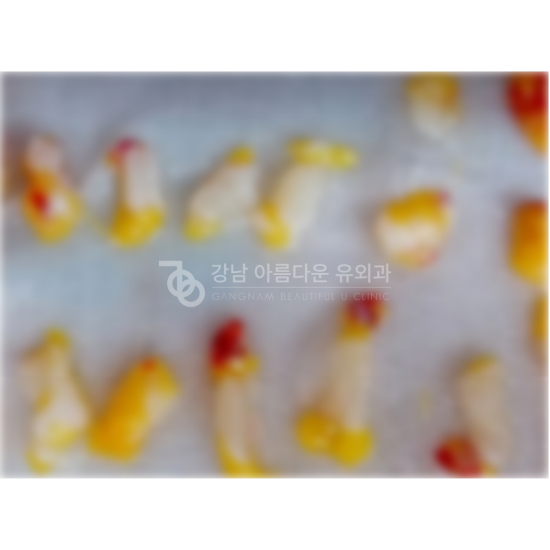 가슴수술후 멍울 제거 맘모톰으로 가능? 직접 확인하세요