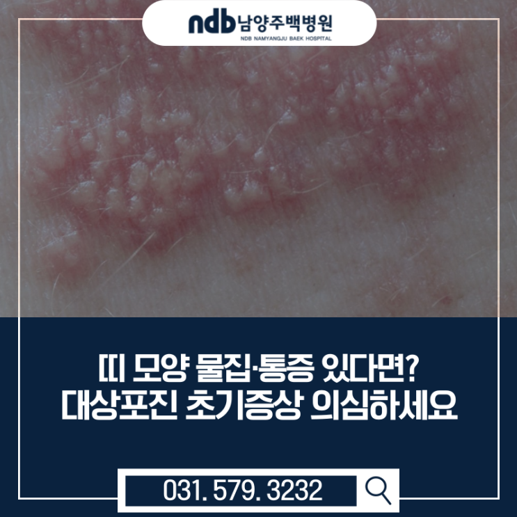  “피부에 띠처럼 물집이?” 대상포진 초기증상, 남양주 치료병원 어디서? 추천!