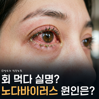 회 먹다 실명? 중국발 눈병 '노다바이러스(CMNV)' 원인 증상 전염 대처법 필독하세요!