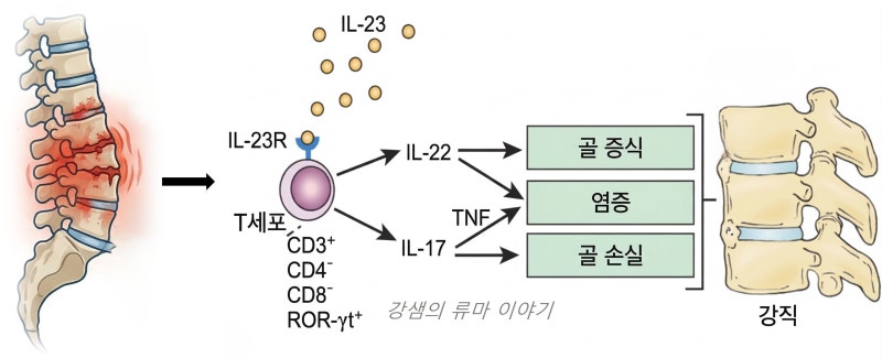 [강직성 척추염 치료 2편] “소염진통제를 먹어도 계속 아파요” – 생물학적 제제와 일상의 ....