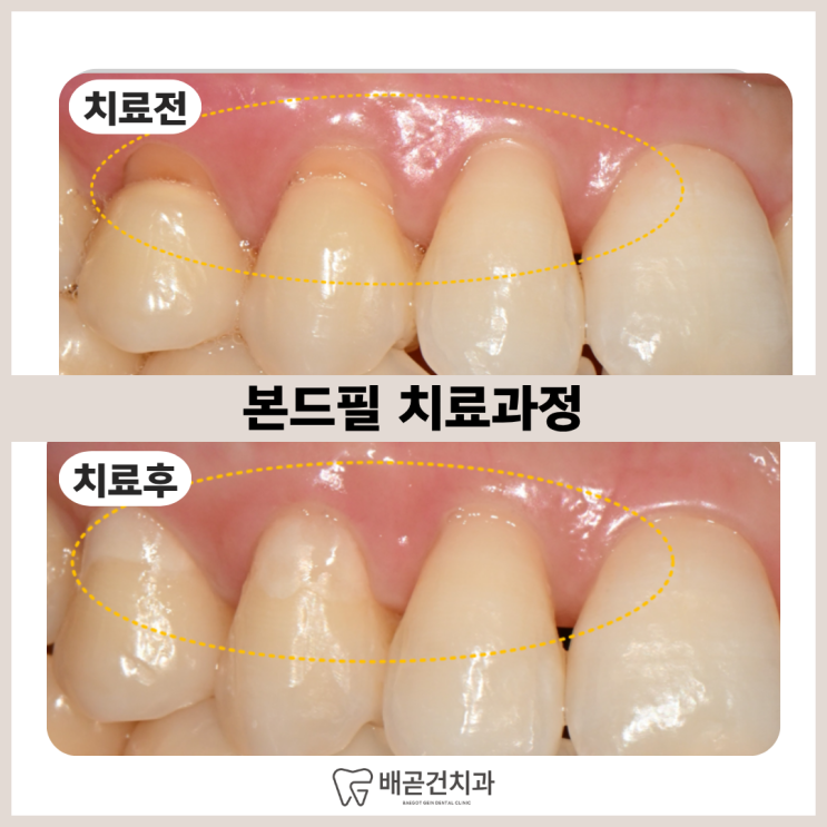  시린 치아, 치경부 마모증일까? 본드필 치료 과정 정리