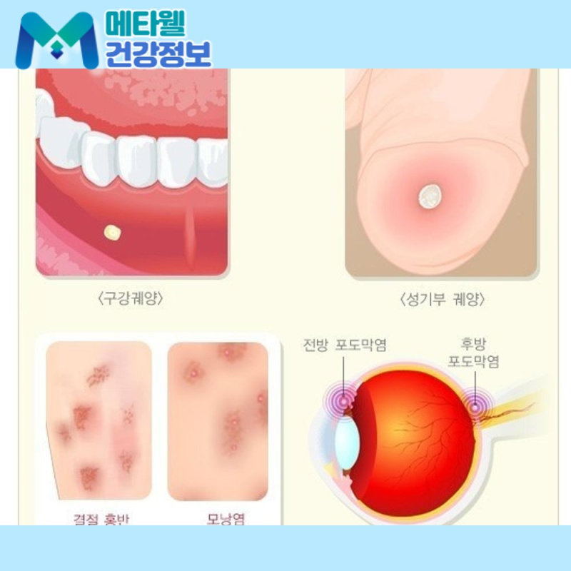 구내염인 줄 알았는데 베체트병일 수 있습니다, 증상과 치료법