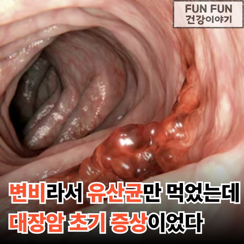 방귀 나오고 변비때문에 유산균만 먹었는데 유상무도 걸린 대장암 초기증상이였다고
