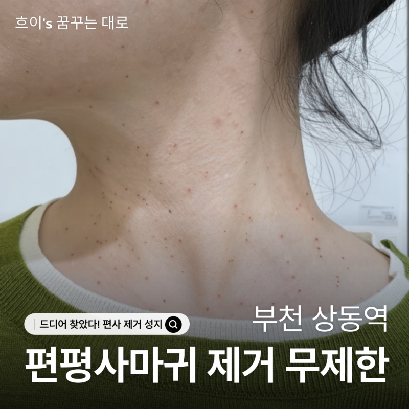 부천 상동역 편평사마귀 제거 무제한 드디어 찾은 편사 성지 여자 원장님 꼼꼼한 시술 후기