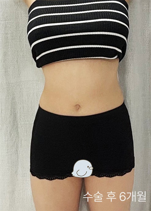  뱃살지방흡입비용 비교 전 필독, 실패 없는 복부지방흡입을 위한 체크리스트