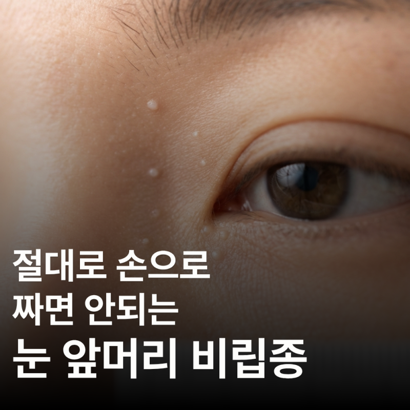 눈 앞머리 비립종, 절대로 손으로 짜지 마세요!