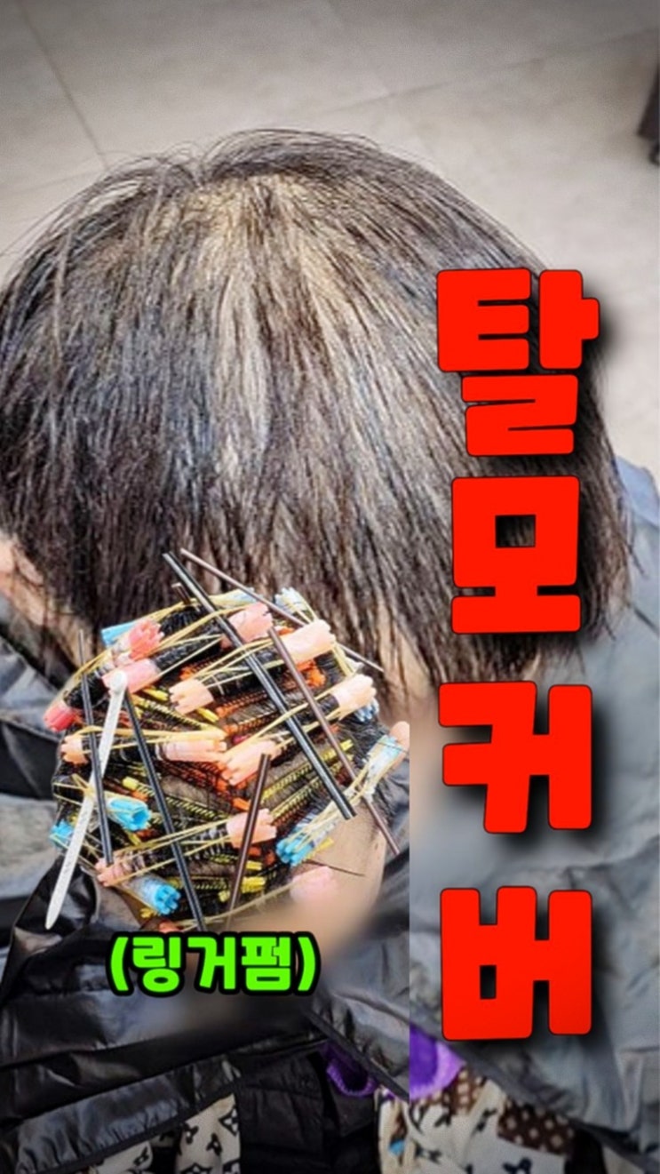  서울 청량리에서 수원까지! 50대 정수리 탈모, 모류교정 링거펌으로 확실하게 채운 후기