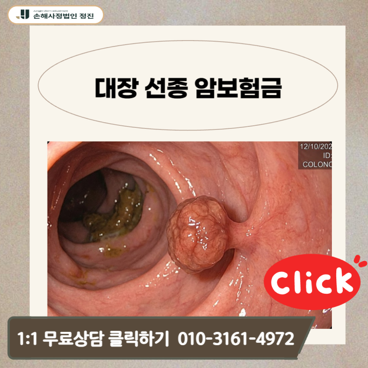  대장 선종 암보험금, D12 코드인데도 수천만 원 수령이 가능한 이유