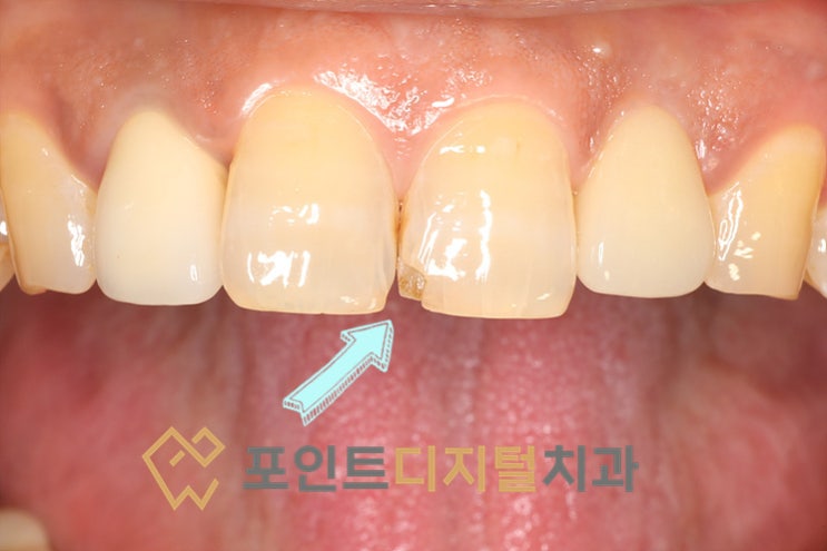 [탕정치과]  앞니 깨짐, 당일 레진수복으로 자연스럽게 복원한 케이스 / 천안 아산