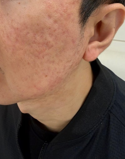 대구여드름흉터 패인 볼 새살침 1회 솔직 후기