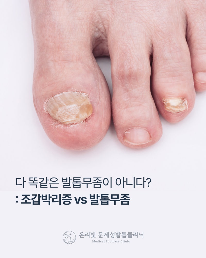 대구발톱무좀초기, 조갑박리증과 다른 점이 있을까?