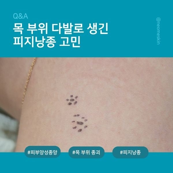 대구 목 부위 다발로 생긴 피지낭종 고민