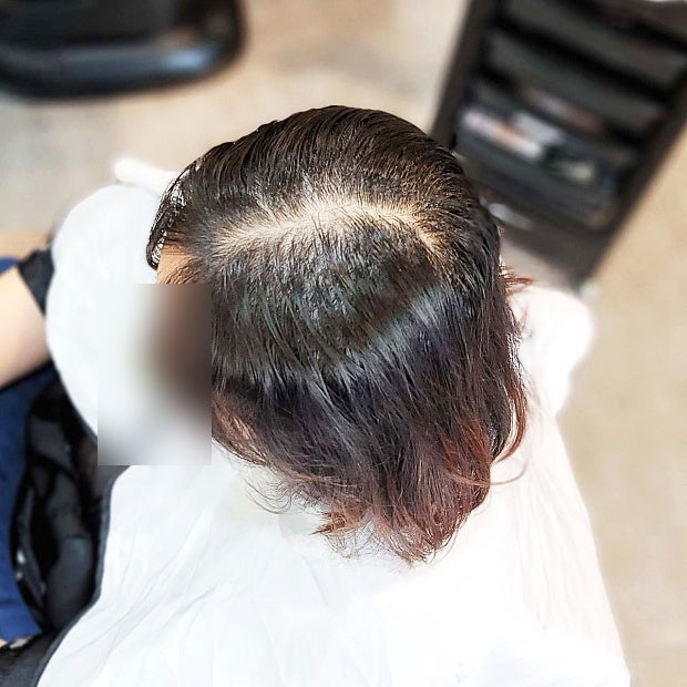 서초구 가르마 갈라짐 고민, 가마 뒤쪽까지 연결되어 휑해 보이는데 링거펌으로 채워질까요?