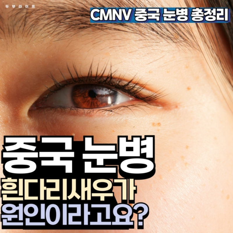 중국 눈병 바이러스 CMNV, 흰다리새우가 원인? 부모가 꼭 알아야 할 것들