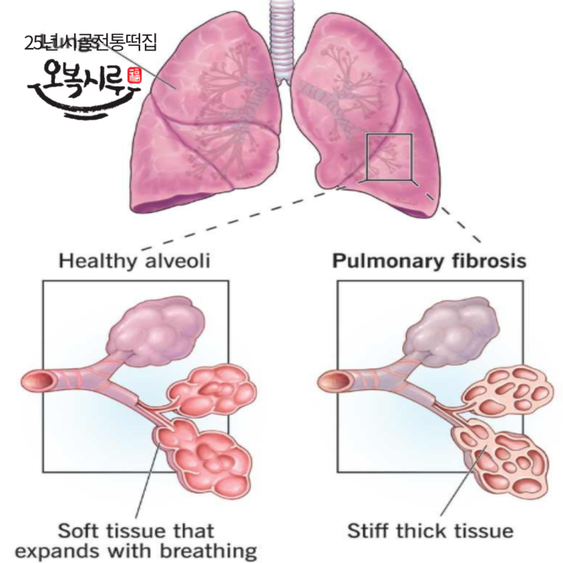 간질성 폐질환 생존율, 너무 겁먹기 전에 알아둘 것