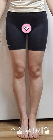 허벅지지방흡입통증과 울퉁불퉁한 요철 걱정? 재생 성장인자의 보존이 결과의 차이를 만드는 이유