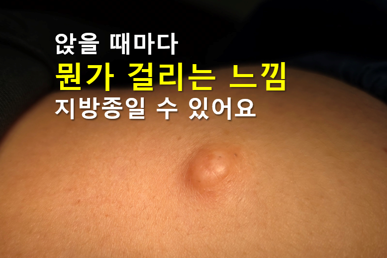 엉덩이 지방종 다른 혹들과 구분하는 방법과 제거 수술까지