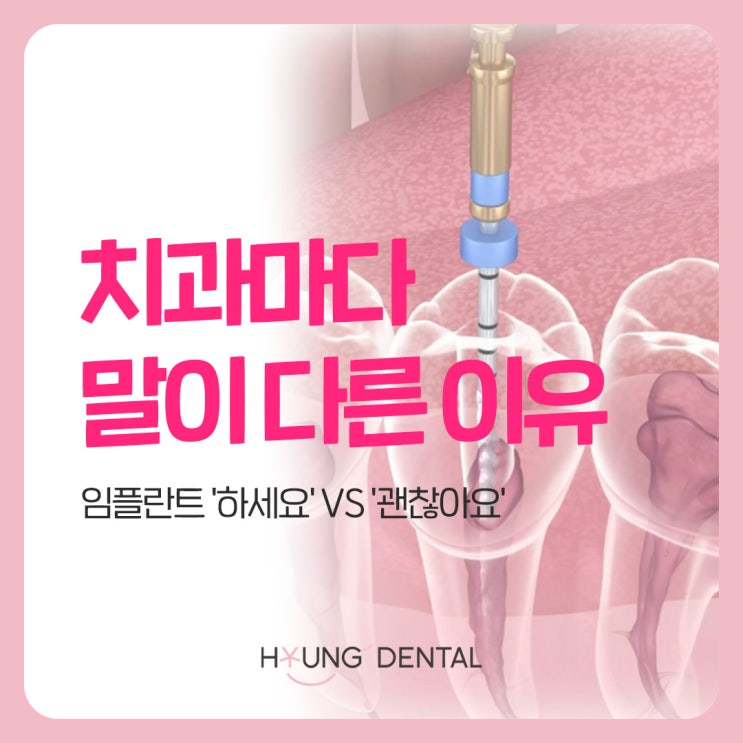  수원 임플란트 치과가 말하는 발치 후 임플란트