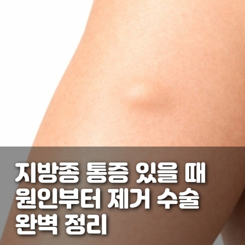 지방종 통증 있을 때 방치하면 안 되는 이유 - 원인부터 제거 수술까지 완벽 정리